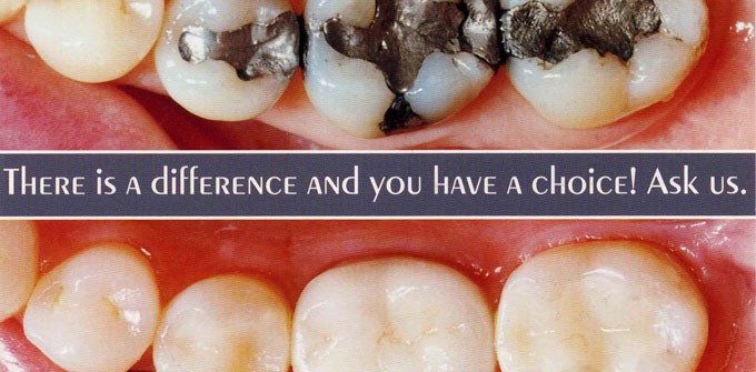 Tooth-Colored Fillings & Crowns