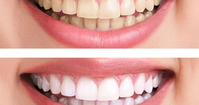 Teeth whitening kits diy